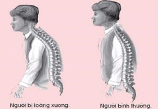 Cách phát hiện loãng xương ở giai đoạn sớm nhất